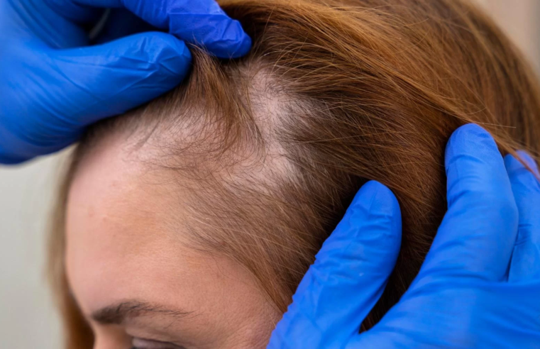 Especialista explica as possíveis causas da perda de cabelo